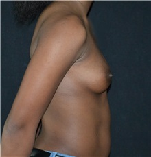 Breast Augmentation Before Photo by Suresh Koneru, MD; ,  - Case 50266