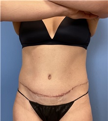 Tummy Tuck After Photo by Suresh Koneru, MD; ,  - Case 50269