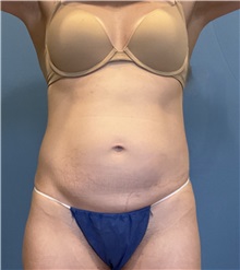 Tummy Tuck Before Photo by Suresh Koneru, MD; ,  - Case 50269