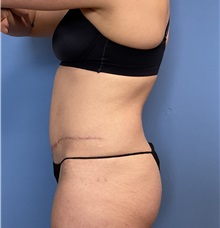 Tummy Tuck After Photo by Suresh Koneru, MD; ,  - Case 50269