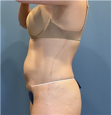 Tummy Tuck Before Photo by Suresh Koneru, MD; ,  - Case 50269