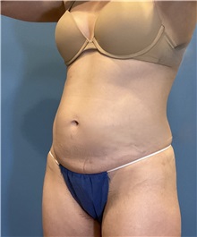 Tummy Tuck Before Photo by Suresh Koneru, MD; ,  - Case 50269