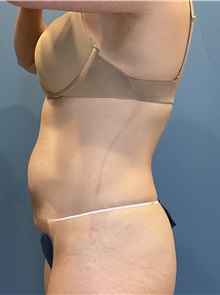 Tummy Tuck After Photo by Suresh Koneru, MD; ,  - Case 50269