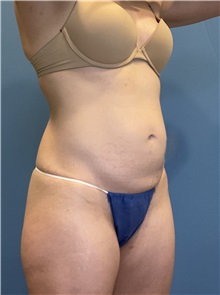 Tummy Tuck Before Photo by Suresh Koneru, MD; ,  - Case 50269