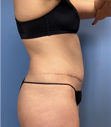 Tummy Tuck After Photo by Suresh Koneru, MD; ,  - Case 50269