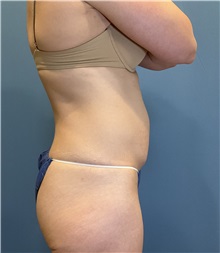 Tummy Tuck Before Photo by Suresh Koneru, MD; ,  - Case 50269