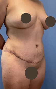 Tummy Tuck After Photo by Suresh Koneru, MD; ,  - Case 50270