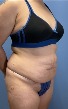 Tummy Tuck Before Photo by Suresh Koneru, MD; ,  - Case 50270