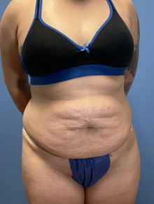 Tummy Tuck Before Photo by Suresh Koneru, MD; ,  - Case 50270