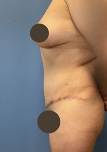 Tummy Tuck After Photo by Suresh Koneru, MD; ,  - Case 50270