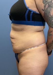 Tummy Tuck Before Photo by Suresh Koneru, MD; ,  - Case 50270