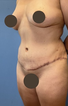 Tummy Tuck After Photo by Suresh Koneru, MD; ,  - Case 50270