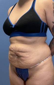 Tummy Tuck Before Photo by Suresh Koneru, MD; ,  - Case 50270