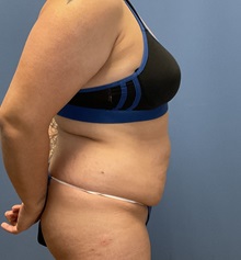 Tummy Tuck Before Photo by Suresh Koneru, MD; ,  - Case 50270