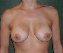 Breast Augmentation After Photo by Steven Wallach, MD; New York, NY - Case 33566
