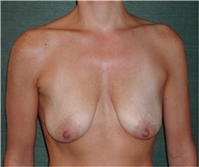 Breast Augmentation Before Photo by Steven Wallach, MD; New York, NY - Case 33566