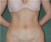 Liposuction After Photo by Steven Wallach, MD; New York, NY - Case 33629