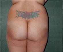 Buttock Lift with Augmentation Before Photo by Steven Wallach, MD; New York, NY - Case 33641
