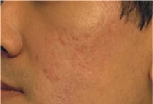Skin rejuvenation and resurfacing After Photo by Steven Wallach, MD; New York, NY - Case 33646
