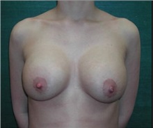 Breast Implant Removal After Photo by Steven Wallach, MD; New York, NY - Case 33654