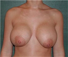 Breast Implant Removal Before Photo by Steven Wallach, MD; New York, NY - Case 33654