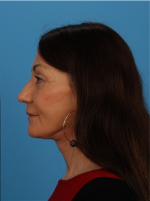 Facelift After Photo by Robert Carpenter, MD; Cumberland, MD - Case 32153