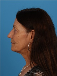 Facelift Before Photo by Robert Carpenter, MD; Cumberland, MD - Case 32153