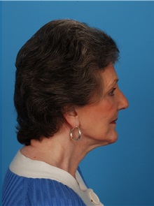Facelift After Photo by Robert Carpenter, MD; Cumberland, MD - Case 32157