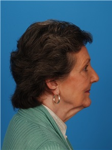 Facelift Before Photo by Robert Carpenter, MD; Cumberland, MD - Case 32157