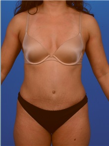 Tummy Tuck After Photo by Robert Carpenter, MD; Cumberland, MD - Case 32160