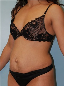 Tummy Tuck Before Photo by Robert Carpenter, MD; Cumberland, MD - Case 32160