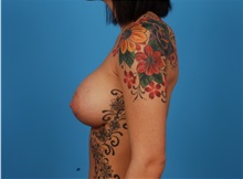 Breast Augmentation After Photo by Robert Carpenter, MD; Cumberland, MD - Case 32167