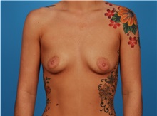 Breast Augmentation Before Photo by Robert Carpenter, MD; Cumberland, MD - Case 32167
