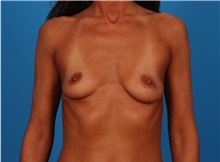 Breast Augmentation Before Photo by Robert Carpenter, MD; Cumberland, MD - Case 32168