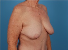 Breast Augmentation Before Photo by Robert Carpenter, MD; Cumberland, MD - Case 32170