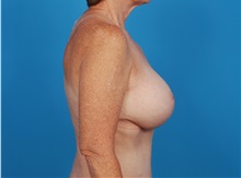 Breast Augmentation After Photo by Robert Carpenter, MD; Cumberland, MD - Case 32170
