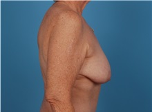 Breast Augmentation Before Photo by Robert Carpenter, MD; Cumberland, MD - Case 32170