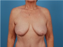 Breast Augmentation Before Photo by Robert Carpenter, MD; Cumberland, MD - Case 32170