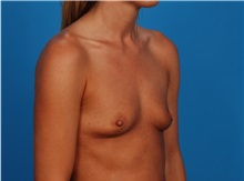 Breast Augmentation Before Photo by Robert Carpenter, MD; Cumberland, MD - Case 32171