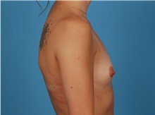 Breast Augmentation Before Photo by Robert Carpenter, MD; Cumberland, MD - Case 32173