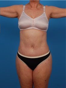 Liposuction After Photo by Robert Carpenter, MD; Cumberland, MD - Case 32174