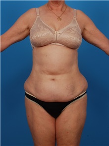 Liposuction Before Photo by Robert Carpenter, MD; Cumberland, MD - Case 32174