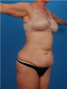 Liposuction Before Photo by Robert Carpenter, MD; Cumberland, MD - Case 32174