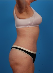 Liposuction After Photo by Robert Carpenter, MD; Cumberland, MD - Case 32174