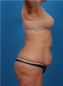 Liposuction Before Photo by Robert Carpenter, MD; Cumberland, MD - Case 32174