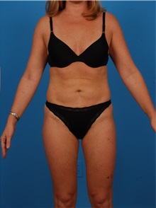 Liposuction After Photo by Robert Carpenter, MD; Cumberland, MD - Case 32177