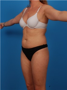 Liposuction Before Photo by Robert Carpenter, MD; Cumberland, MD - Case 32177