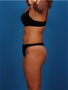 Liposuction After Photo by Robert Carpenter, MD; Cumberland, MD - Case 32177