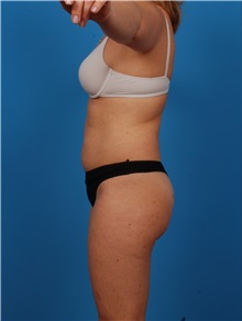 Liposuction Before Photo by Robert Carpenter, MD; Cumberland, MD - Case 32177