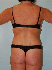 Liposuction After Photo by Robert Carpenter, MD; Cumberland, MD - Case 32178
